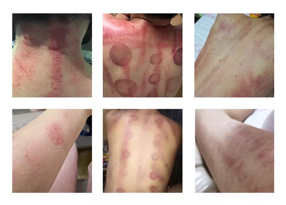 Luma “6 In 1” 80K Smart Lipo-Cavitation™